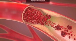 Anemi (Kansızlık) nedir? Kansızlığın belirtileri nelerdir? Kansızlığa iyi gelen besinler…