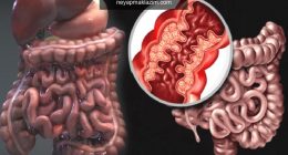 Crohn hastalığı nedir? Crohn hastalığının belirtileri nelerdir? Crohnun tedavisi var mıdır?