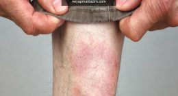 Lyme hastalığı nasıl ortaya çıkar? Lyme belirtileri nelerdir? Lyme hastalığı tedavisi var mıdır?