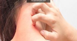Nilüfer’den üzücü haber! Mantar enfeksiyonu nedir? Kaç çeşit mantar enfeksiyonu vardır?