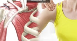 Tendinit hastalığı nedir? Tendinit hastalığı belirtileri nelerdir? Tendinit hastalığı geçer mi?