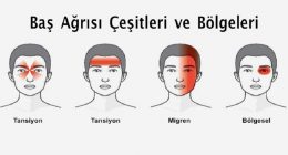Baş ağrısı çeşitleri ve bölgeleri